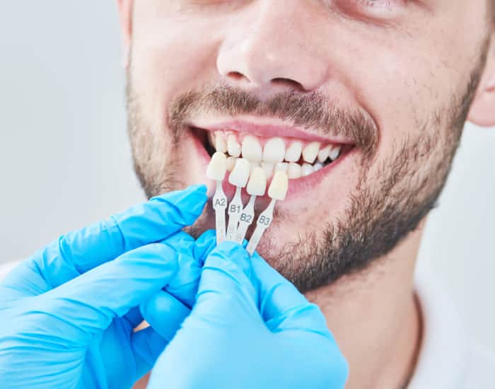 Tooth Coloured Fillings