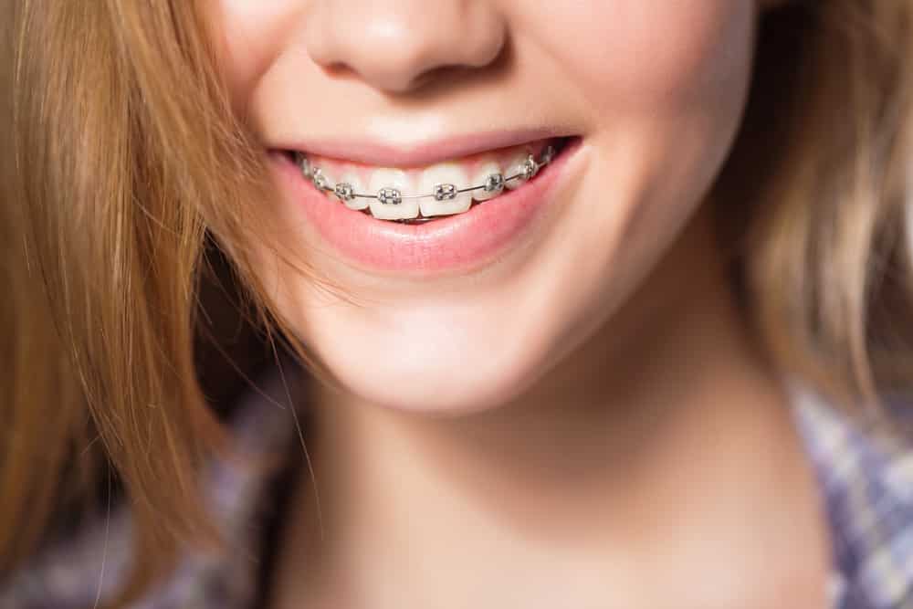 How Early Should You Visit the Orthodontist?