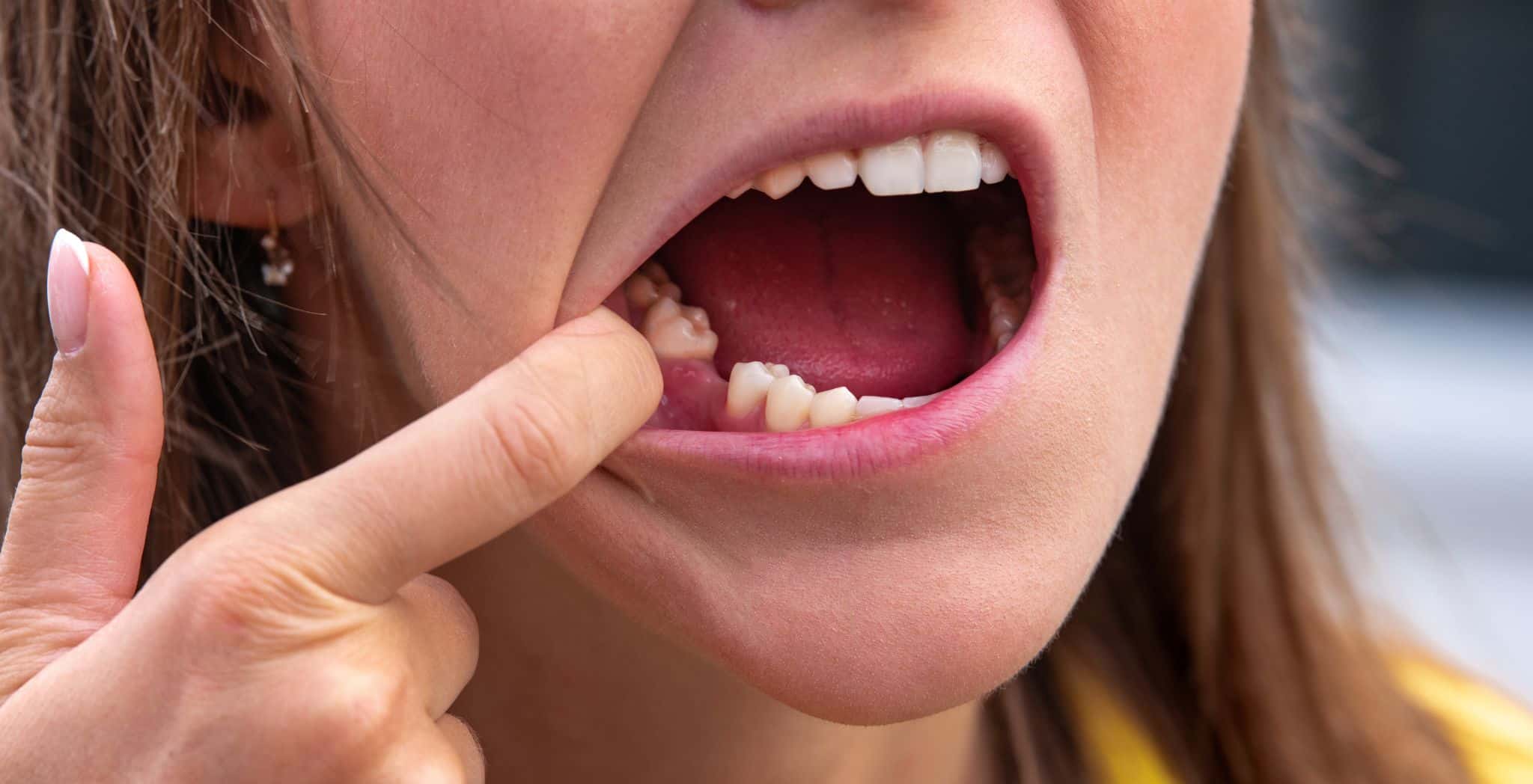 Is dry socket dangerous, Dry socket after tooth extraction, Dry socket complications, Dry socket symptoms, Healing from dry socket, How serious is dry socket, Dental extraction care, Dry socket pain relief, Preventing dry socket, Treatment for dry socket, Risks of untreated dry socket, Tooth extraction infection, Oral surgery aftercare