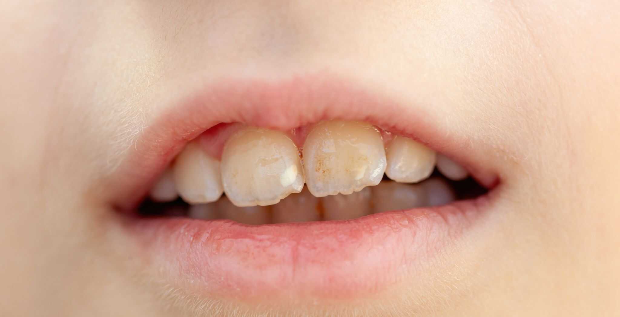 Causes of dental erosion, Tooth enamel erosion factors, Acidic foods and dental erosion, Plaque buildup and dental erosion, Poor oral hygiene causing enamel erosion, Bruxism and dental erosion, Impact of soda on dental erosion, Teeth grinding and enamel wear, Acid reflux leading to dental erosion, Environmental factors in dental erosion, How sugary drinks cause dental erosion, Dental erosion from frequent snacking, The role of stomach acid in tooth erosion, Preventing dental erosion, Dental erosion from improper brushing techniques, dental erosion causes